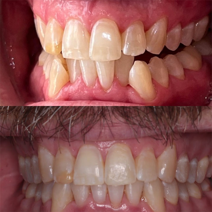 Before and After #11 Photo