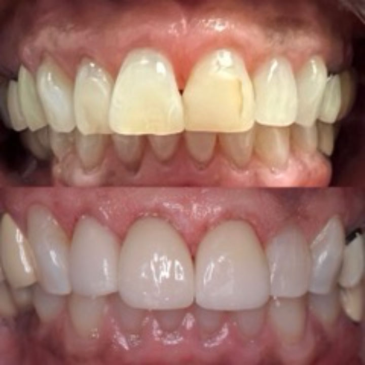 Before and After #13 Photo